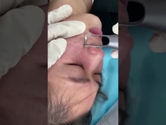 van de de Salonpicoseconde van 1064nm 532nm de Lasermachine voor de Behandeling van het de Letselsprobleem van de Huidpigmentatie